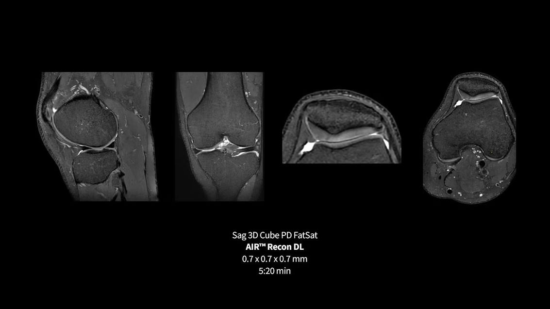 GE SIGNA Premier клиническое МРТ изображение