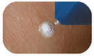 Cryomega II, Cryomega 2, Skin tag removal, skin tags, warts removal, lesion removal, freeze warts, cryo equipment, cryo pen, cryo alpha