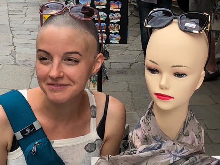 Alopecia Series, Part 1: What Exactly is Alopecia Areata?