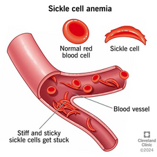 The Future of Sickle Cell Disease