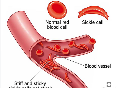 The Future of Sickle Cell Disease