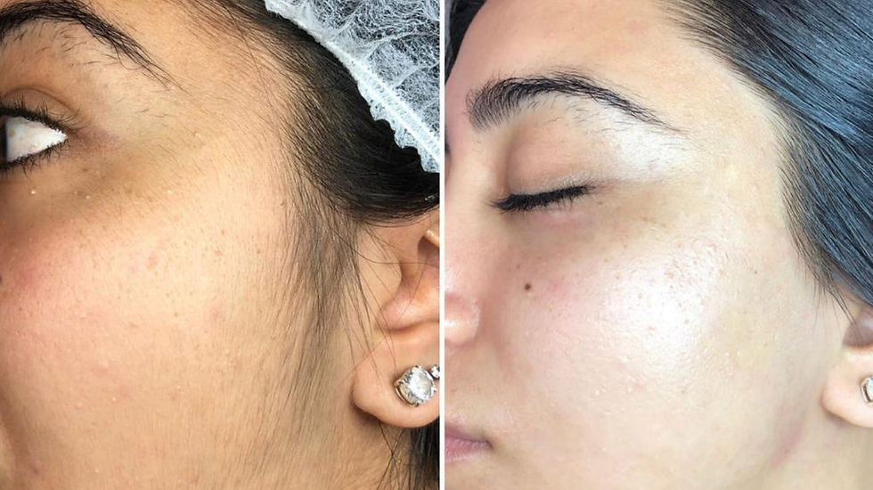 Dermaplaning skin before and after