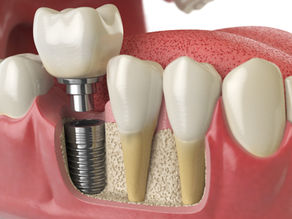 ¿Qué es un Implante Dental?