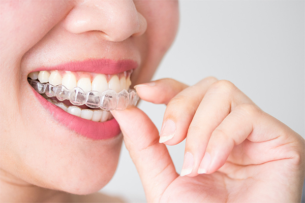 Invisalign — alinhadores transparentes