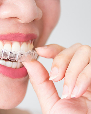 invisalign flavia mitiko.jpg