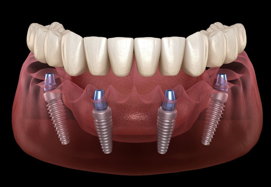Dentures and tooth replacement options