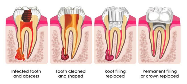 root canal.png