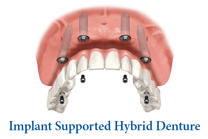 Hybrid.png