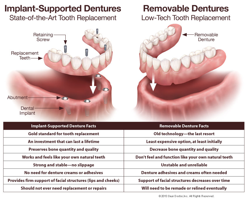 implant-supported-dentures-vs-removable-