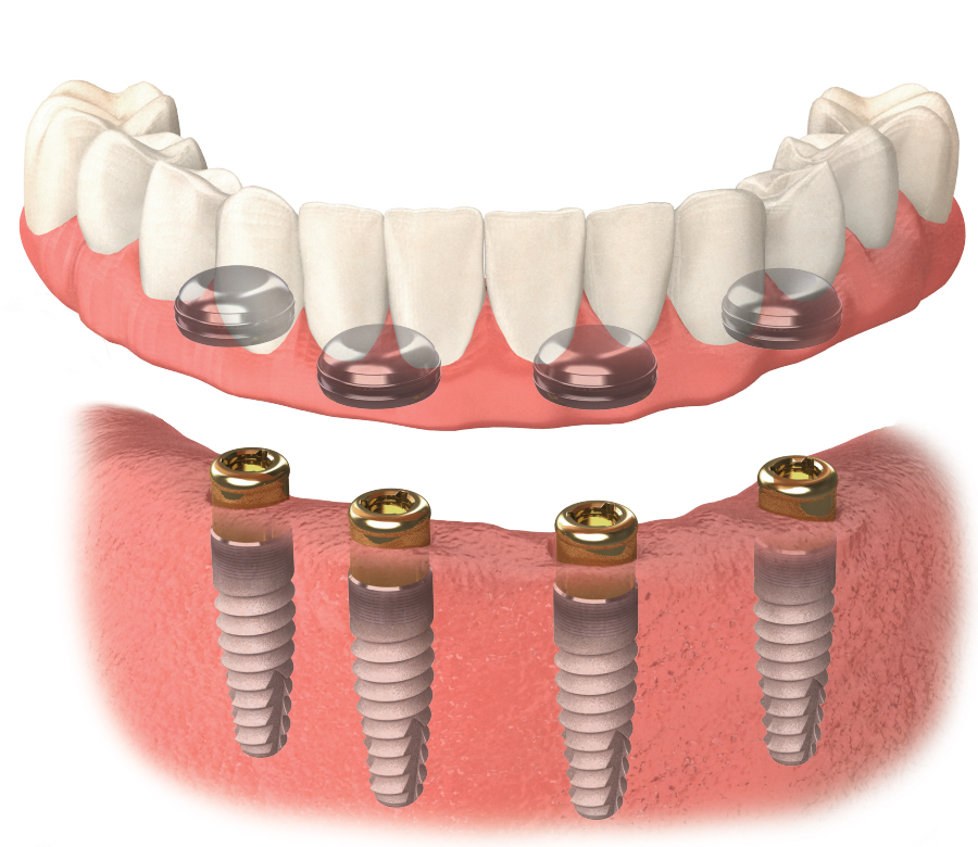 Overdenture.jpg