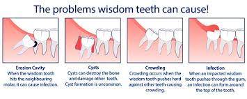 Wisdom teeth.jfif