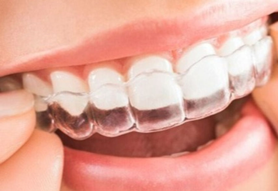 Invisalign clear aligner treatment