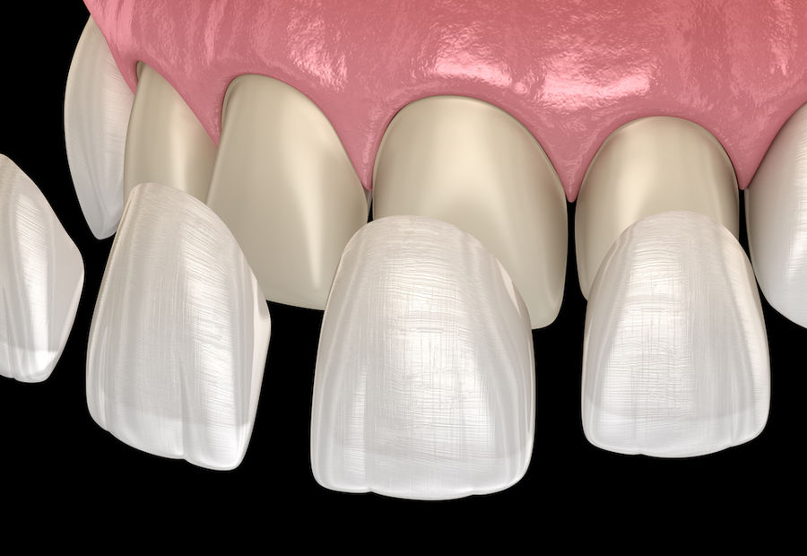 Cosmetic dentistry smile enhancement