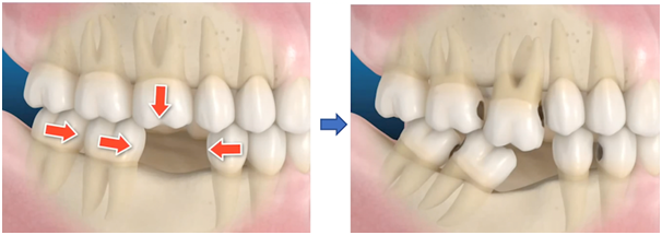 Consequences of missing teeth.png