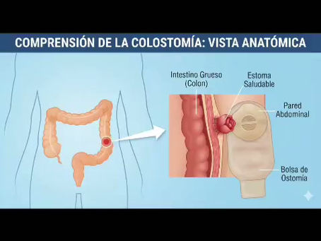 UNA OSTOMIA PUEDE CAMBIAR TU VIDA PARA BIEN, PODEMOS SER TU GUÍA EN EL PROCESO