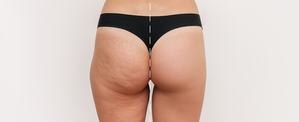 Before and after cellulite treatment on buttocks and thighs in Wichita KS – Avéli™ results shown on female patient