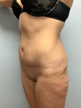Angled view 7 months after abdominoplasty showing tightened abdominal contour and smooth skin.
