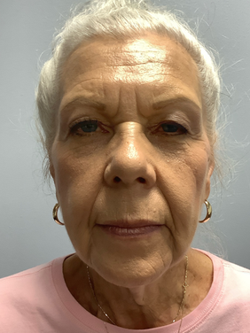 Before facelift and neck lift front view of mature woman at Plastic Surgery Wichita KS.