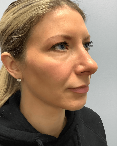 Rhinoplasty after photo right oblique view showing softened bridge contour and natural nasal refinement