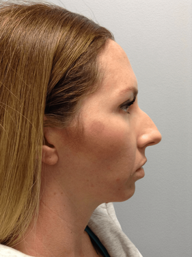 Before rhinoplasty right profile view showing nasal projection and bridge shape prior to surgery in Wichita KS