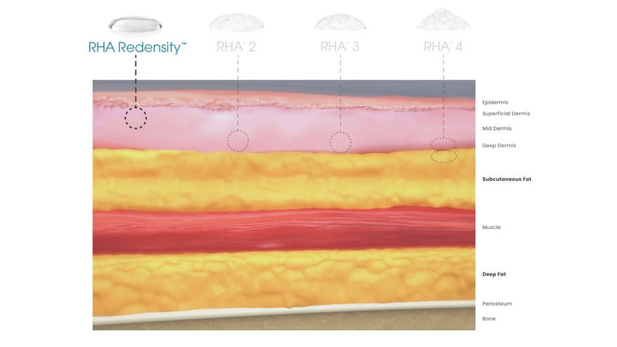 Cross-section showing RHA 2, 3, and 4 filler depth placement for dynamic wrinkle correction in Wichita KS med spa treatments