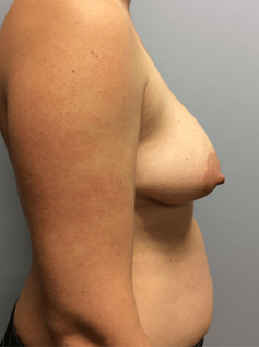 Side profile before mastopexy showing decreased upper pole fullness and breast droop.
