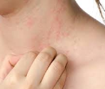 eczema.png