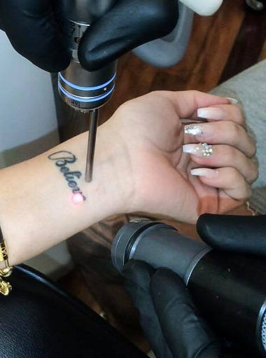 wrist tattoo removal