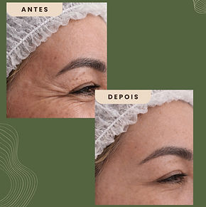 Antes e depois de botox para pés de galinha - Dra. Erika Silva, Biomédica Esteta no Ipiranga, São Paulo