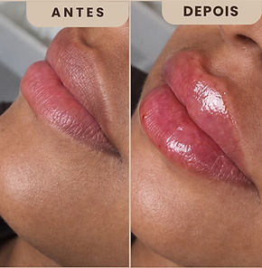Antes e depois de preenchimento labial - Dra. Erika Silva, Biomédica Esteta no Ipiranga, São Paulo