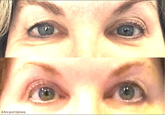 before-and-after-upneeq.png