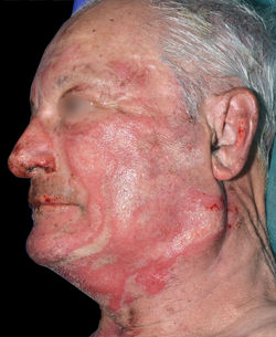 Brûlure 2nd degré superficiel