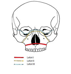 Traits de fracture des Lefort