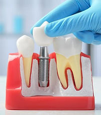 dental implants_edited.jpg