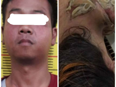 Karena Cemburu, Pria Ini Siram Pacar dengan Air Keras 