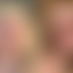 Exreina de belleza comparte su lucha contra el acné, pasó de unos granitos a quistes del tamaño de una uva.