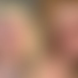 Exreina de belleza comparte su lucha contra el acné, pasó de unos granitos a quistes del tamaño de una uva.