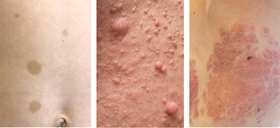 Neurofibromatose-Symptome auf der Haut (Café-au-lait-Flecken, Neurofibrome, plexiformes Neurofibrom)