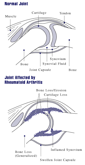 Rheumatoid Arthritis