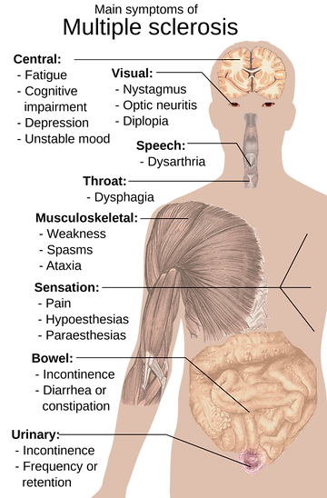Symptoms of Multiple Sclerosis