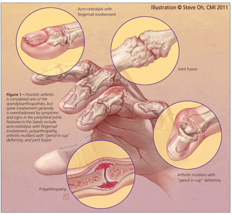 Psoriatic Arthritis