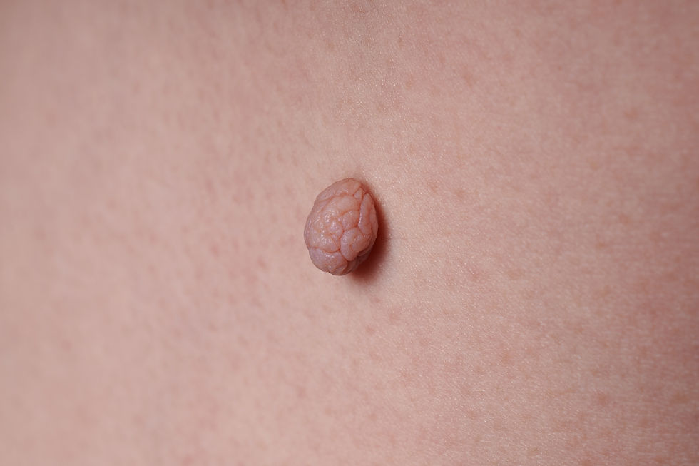 large-round-papilloma-benign-mole-body-medical-examination-dermatologist-oncologist.jpg