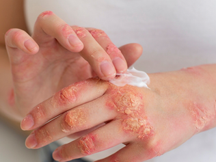 On-Demand Wound Care: Inovasi dalam Perawatan Luka