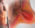 Cirugía de Hernia Inguinal en Querétaro