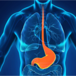 Reflujo Gastroesofágico