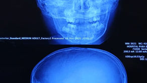 Logra Puebla primer lugar nacional en colocación de implantes cocleares