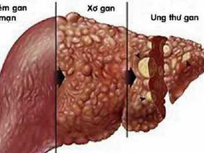 VIÊM GAN C: KHI NÀO DẪN ĐẾN XƠ GAN VÀ UNG THƯ GAN?