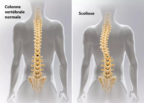 Comparaison colonne vertébrale avant et après traitement par traction lombaire Lyon 8