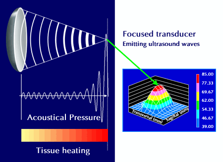 HIFU for prostate cancer involves heating tissue with clean energy to destroy it.