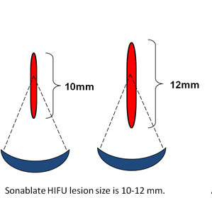 Sonablate HIFU lesion size